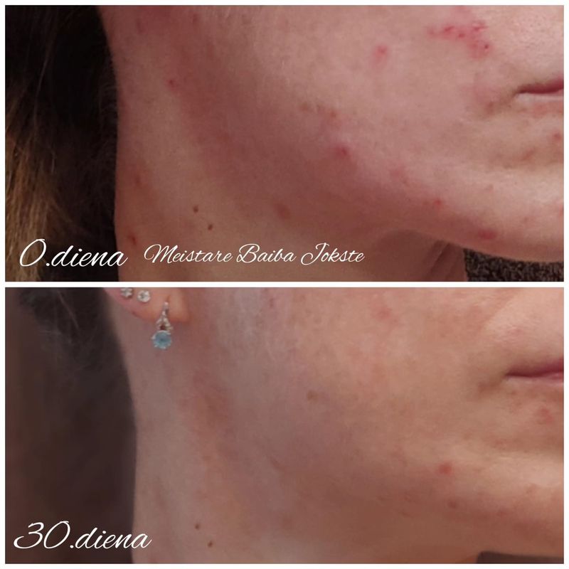 Hormonālā akne, BHA ampula, Thesera