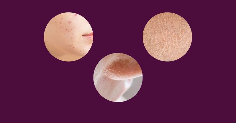 akne, poras, sausa āda