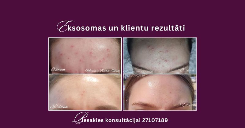 pinnes,akne, thesera, eksosomas